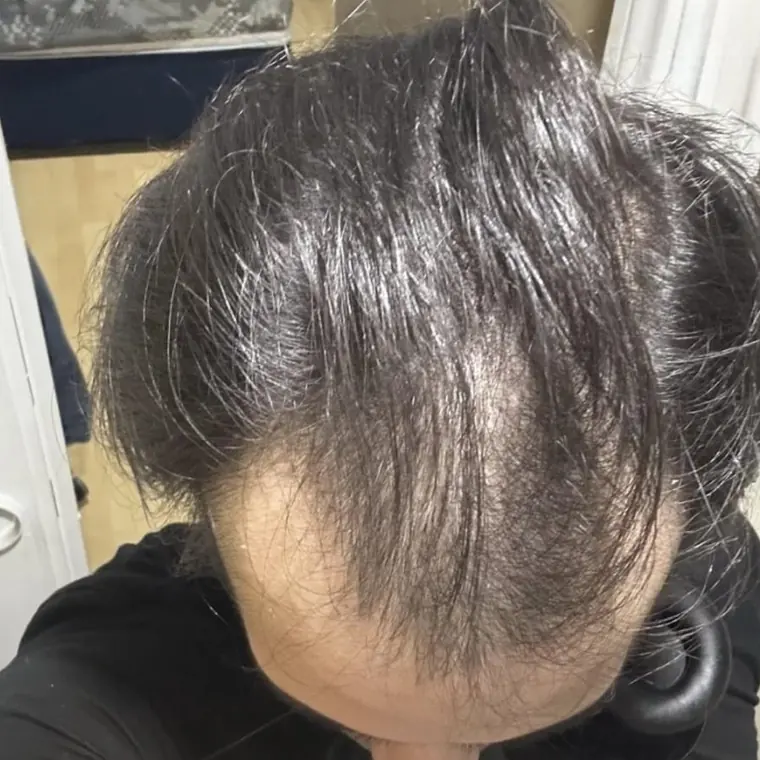 Alopécie diffuse — femme — avant